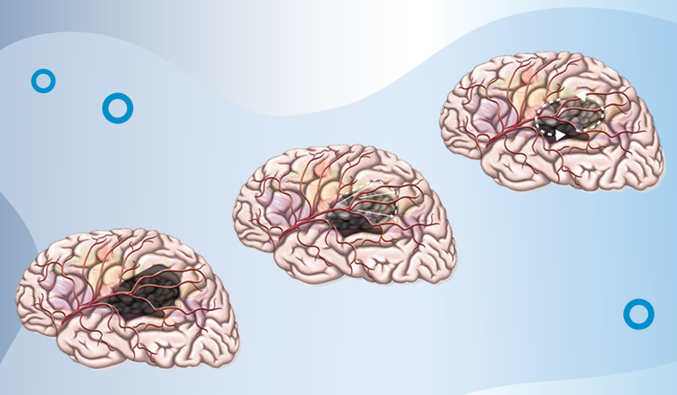 Gliom-Therapie: neue Bücher für Neurochirurgen und Neuroradiologen